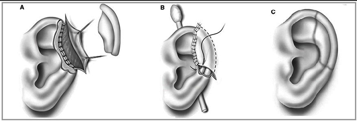 Chirurgie de l'oreille pour les oreilles tombantes. Quel est le prix
