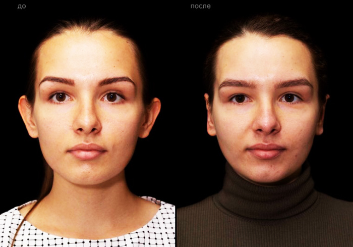 Chirurgie de l'oreille pour les oreilles tombantes. Quel est le prix