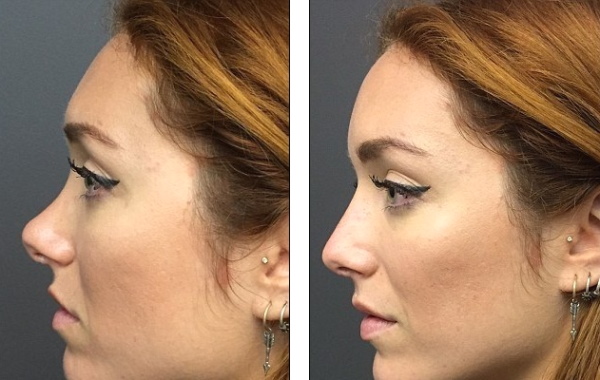 La fille a le nez retroussé. Comment réparer les photos avant et après la rhinoplastie