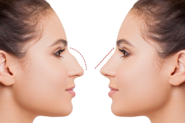 La fille a le nez retroussé. Comment réparer les photos avant et après la rhinoplastie