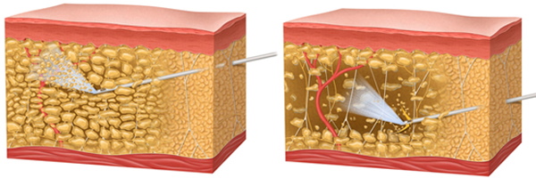 Liposuccion de l'intérieur de la cuisse. Photos avant et après, prix